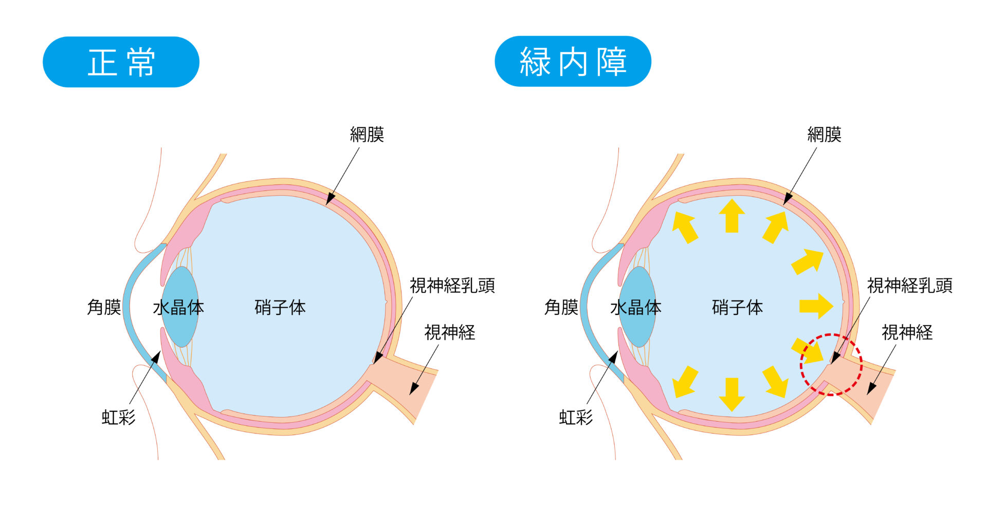 All About 原発閉鎖腺角膜内障 原発閉塞隅角緑内障（Primary Angle