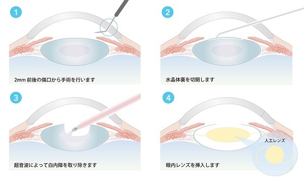 白内障手術