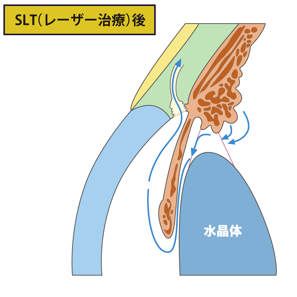 SLT(レーザー治療)後