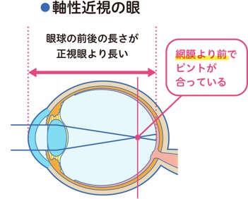 【画像】軸性近視の眼 網膜より前でピントが合っている