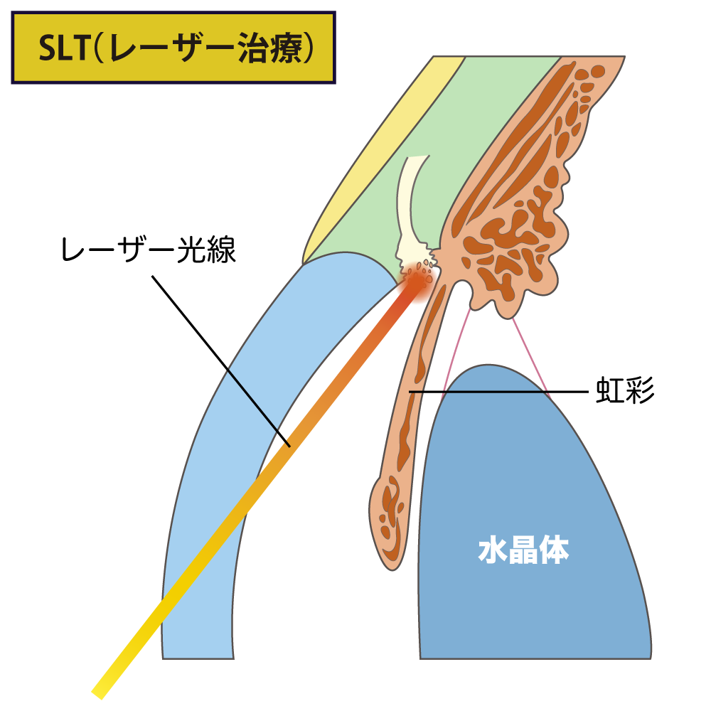 SLT(レーザー治療)