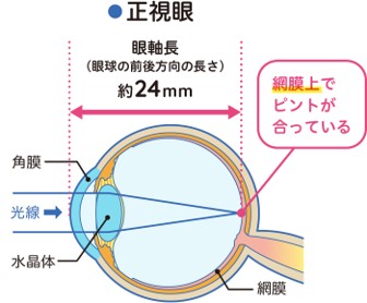 【画像】正視眼 網膜上でピントが合っている