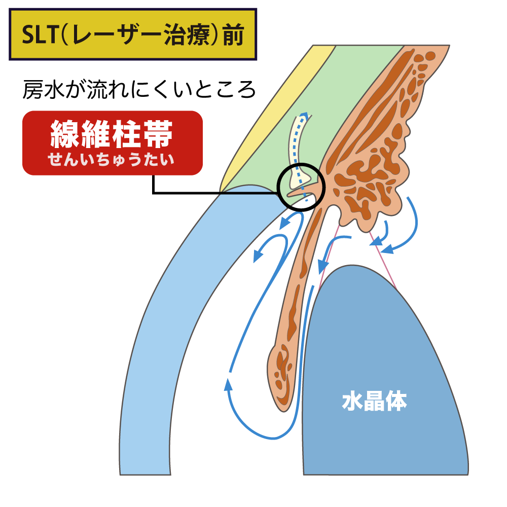 SLT(レーザー治療)前