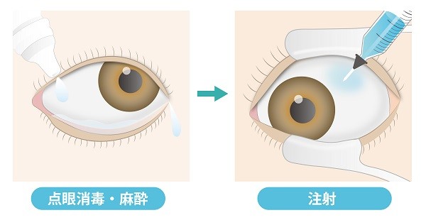 【イラスト】抗VEGF治療